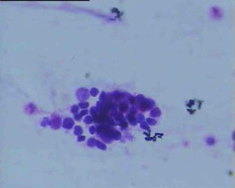 痰脱落细胞 63岁男，请各位老师会诊图7
