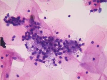 33岁，宫颈液基，H-E染色。图14