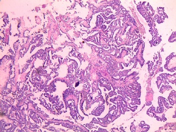 左侧乳腺肿瘤图1