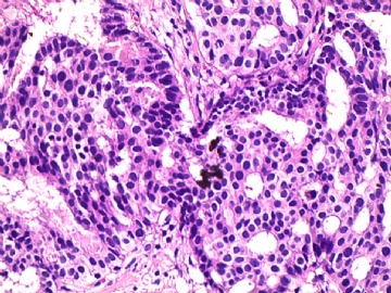 左侧乳腺肿瘤图13