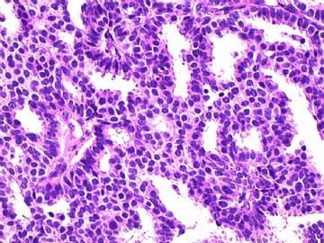 左侧乳腺肿瘤图18