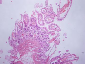 谈东风病例6 Case T0006   62岁女性, 下腹痛10周,十二指肠活检图1