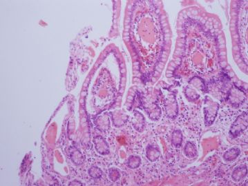 谈东风病例6 Case T0006   62岁女性, 下腹痛10周,十二指肠活检图2