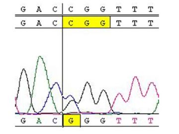 Wilson's Disease（Wilson氏病）图1