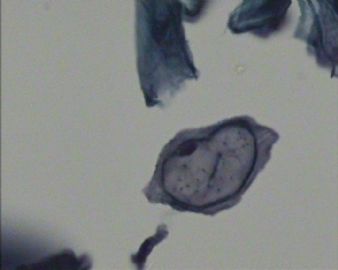 38岁 TCT HPV？请各位老师指教图2