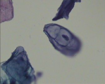 38岁 TCT HPV？请各位老师指教图5