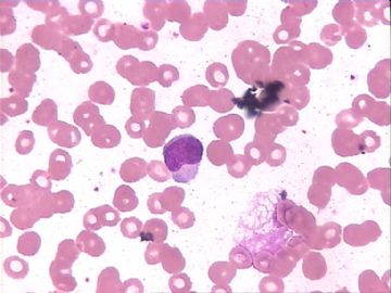 血片细胞图12