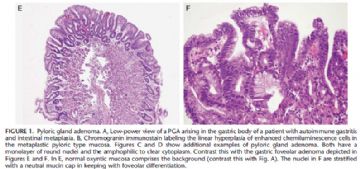幽门腺异型增生/腺瘤 图片 （Am J Surg Pathol 2009;33:186-193)图3