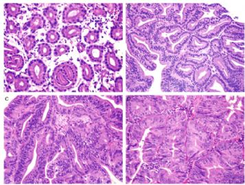 幽门腺异型增生/腺瘤 图片 （Am J Surg Pathol 2009;33:186-193)图4