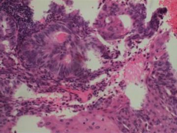 子宫内膜非典型息肉状腺肌瘤（atypical polypoid adenomyoma）图4