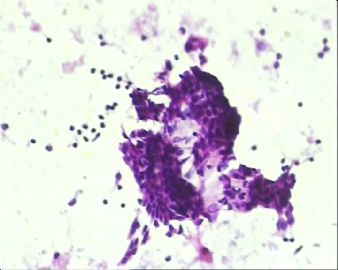 甲状腺右叶肿块穿刺检查图6