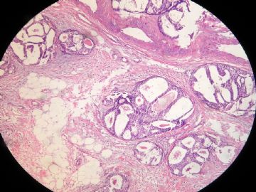 乳腺导管内癌，哪几张伴早期浸润？图4