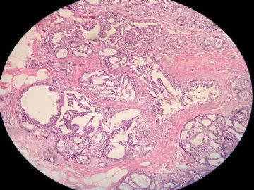 乳腺导管内癌，哪几张伴早期浸润？图6
