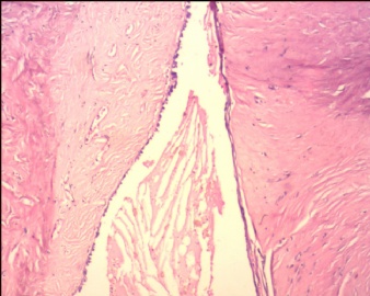 右侧卵巢混合性囊肿图1