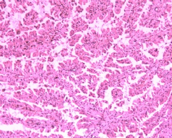 肾脏乳头状腺瘤OR乳头状肾细胞癌？（20102049）图2