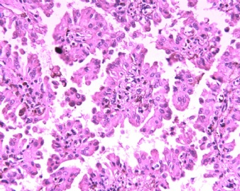 肾脏乳头状腺瘤OR乳头状肾细胞癌？（20102049）图3