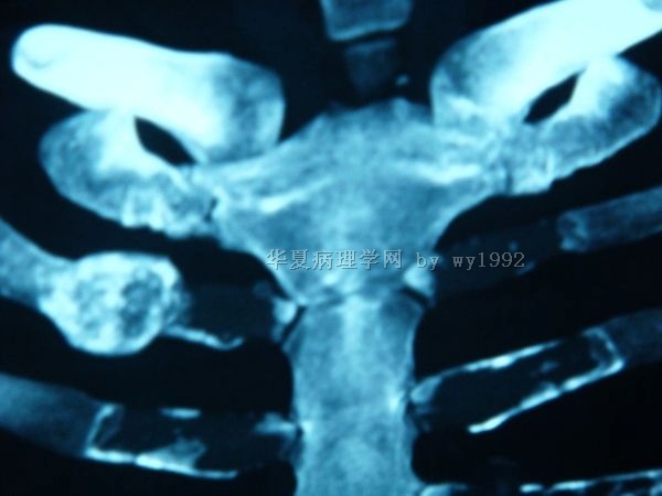 201004294右第二肋骨肿瘤图13