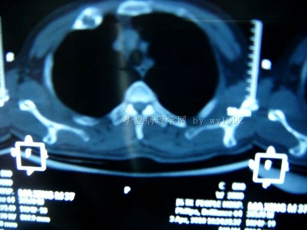 201004294右第二肋骨肿瘤图17