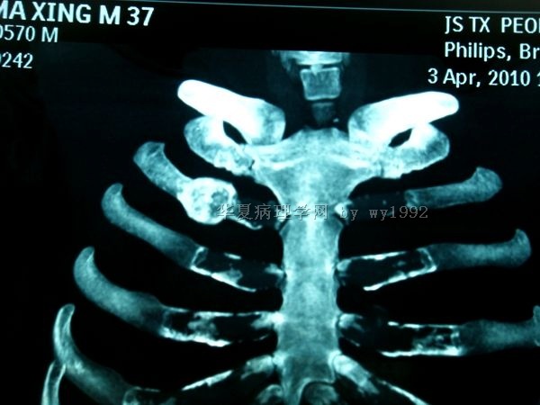 201004294右第二肋骨肿瘤图18