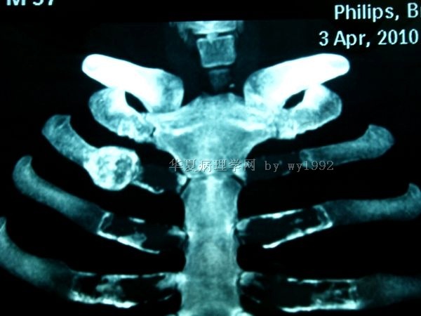 201004294右第二肋骨肿瘤图19