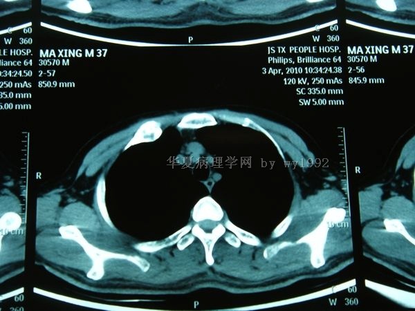 201004294右第二肋骨肿瘤图20