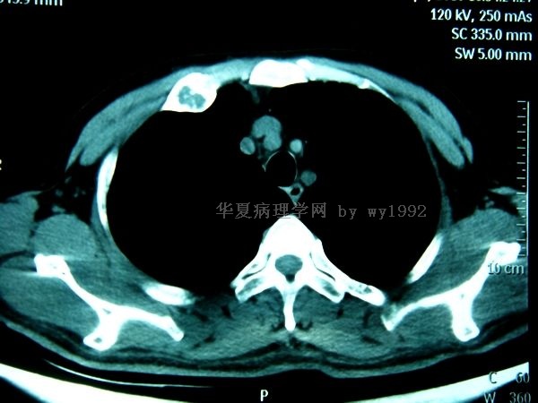 201004294右第二肋骨肿瘤图21