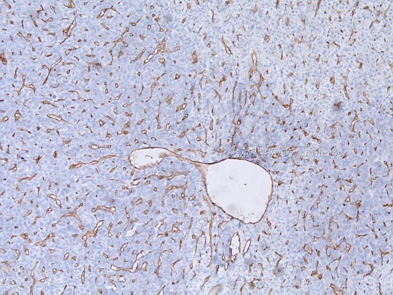 CD34等标记物在肝癌诊断中的价值——病例实例图3