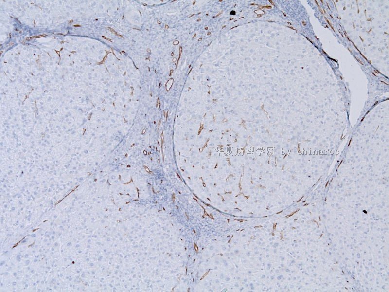 CD34等标记物在肝癌诊断中的价值——病例实例图4