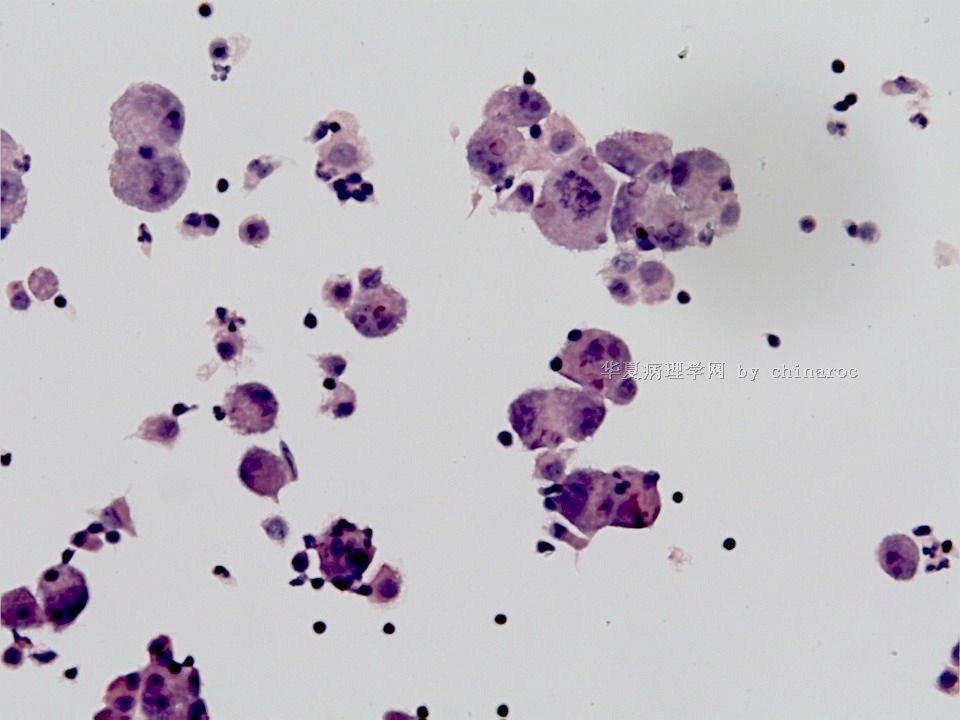 肝脏病例第31例-地坛（液基细胞学）图3