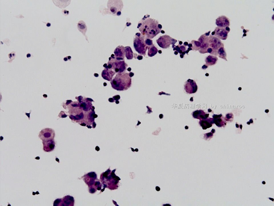 肝脏病例第31例-地坛（液基细胞学）图5