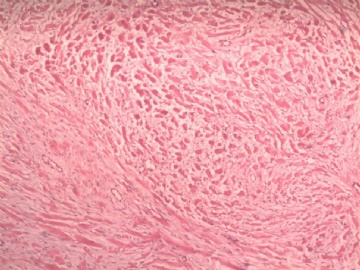 阑尾系膜内肿物（纤维瘤病）图2