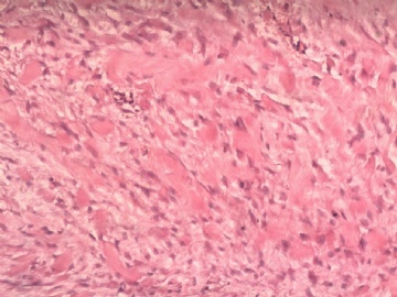 阑尾系膜内肿物（纤维瘤病）图4