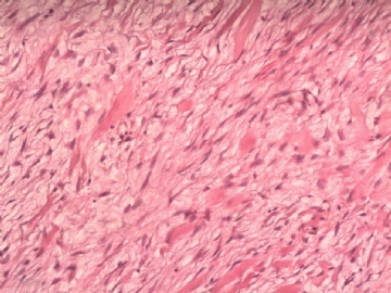阑尾系膜内肿物（纤维瘤病）图5