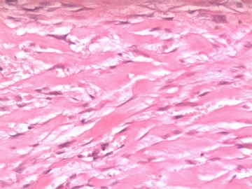 阑尾系膜内肿物（纤维瘤病）图6
