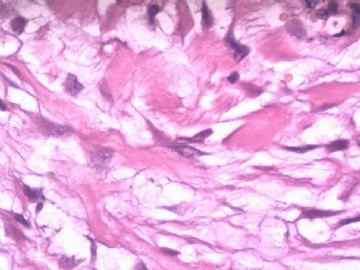 阑尾系膜内肿物（纤维瘤病）图8