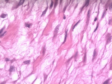 阑尾系膜内肿物（纤维瘤病）图9