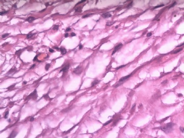 阑尾系膜内肿物（纤维瘤病）图11
