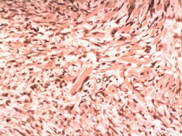 阑尾系膜内肿物（纤维瘤病）图12