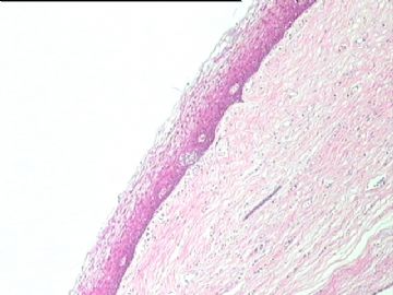 细胞学未找到异型细胞，而全宫切除子宫颈见到区域性CIN2，如何解释。图1