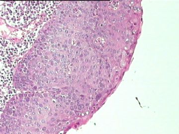 细胞学未找到异型细胞，而全宫切除子宫颈见到区域性CIN2，如何解释。图9