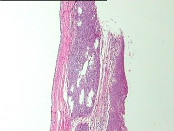 细胞学未找到异型细胞，而全宫切除子宫颈见到区域性CIN2，如何解释。图10