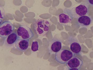血涂片 中的细胞是那种细胞图2
