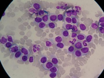 血涂片 中的细胞是那种细胞图3