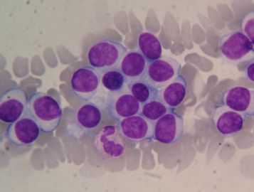 血涂片 中的细胞是那种细胞图4