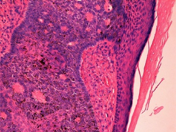 左大腿内侧皮肤发生的肿瘤-病理诊断的两难性(已有诊断结果和会诊意见)图8