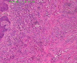 此列该如何诊断呢，皮肤纤维组织细胞瘤？图4