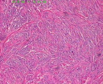 此列该如何诊断呢，皮肤纤维组织细胞瘤？图5