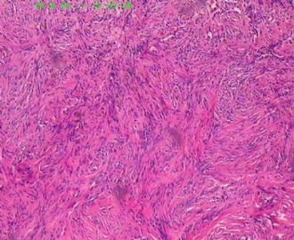 此列该如何诊断呢，皮肤纤维组织细胞瘤？图7