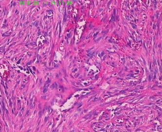 此列该如何诊断呢，皮肤纤维组织细胞瘤？图9