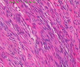 此列该如何诊断呢，皮肤纤维组织细胞瘤？图11